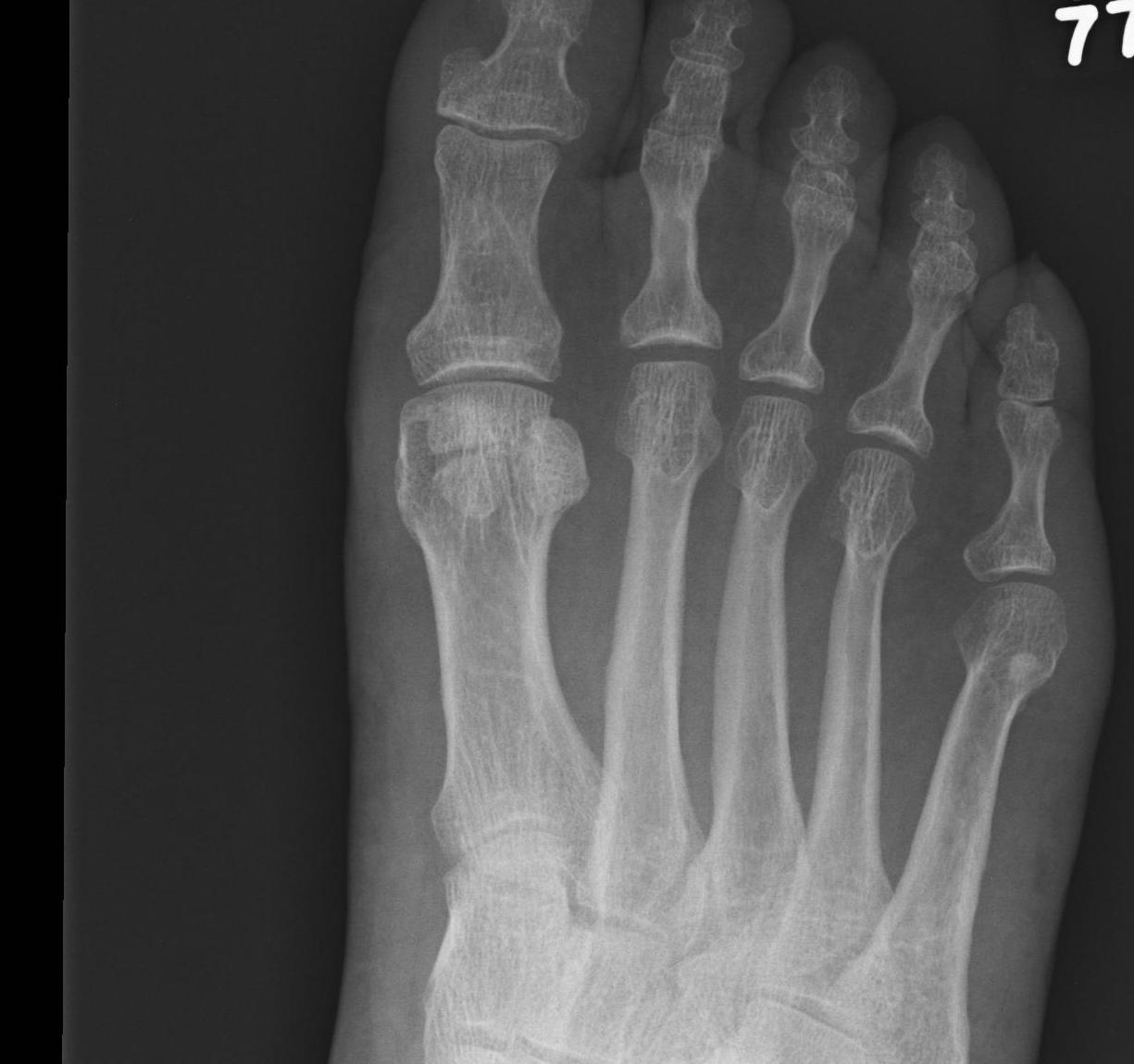 Bipartite Sesamoid